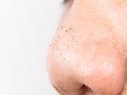 Blackheads and Whiteheads: ब्लैकहेड्स और व्हाइटहेड्स से हैं परेशान, तो ये देसी नुस्खे हैं आप की समस्या का समाधान Blackheads and Whiteheads: ब्लैकहेड्स और व्हाइटहेड्स से हैं परेशान, तो ये देसी नुस्खे हैं आप की समस्या का समाधान