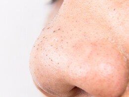 Blackheads हटाने नींबू के साथ ये चीज मिलाकर करें इस्तेमाल, 5 मिनट में छूमंतर हो जाएंगे ब्लैकहेड्स Blackheads हटाने नींबू के साथ ये चीज मिलाकर करें इस्तेमाल, 5 मिनट में छूमंतर हो जाएंगे ब्लैकहेड्स