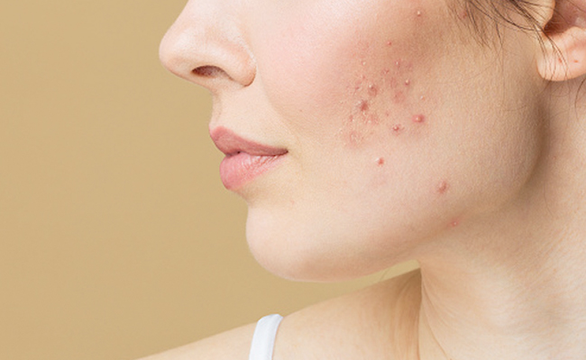 Kitchen में रखी यह सफेद चीज ब्लैकहैड्स, कील- मुंहासे से दिलाएगी छुटकारा, चेहरे की रंगत जाएगी निखर