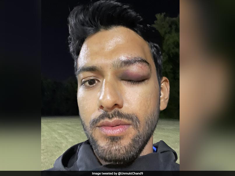 "Grateful To God To Have Survived A Possible Disaster": Unmukt Chand Shares Pics Of Eye Injury