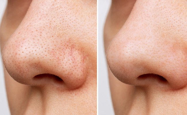 Beauty tips : जिद्दी Blackhead को इन उपायों के साथ हटाएं नाक से, फिर देखिए कैसे चमक जाती है skin
