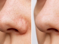 Dry, Flaky Skin Around Your Nose? Try These Simple Fixes
