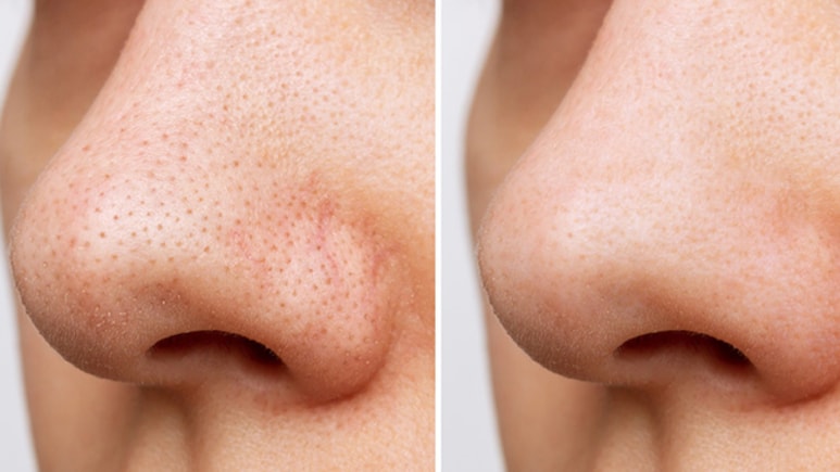 Dry, Flaky Skin Around Your Nose? Try These Simple Fixes