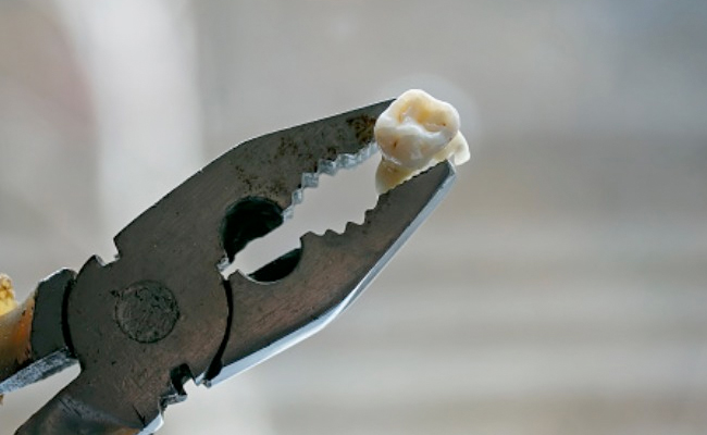 UK Man Who "Couldn't Get Dentist Appointment" For 15 Years Pulls Out His Own Teeth