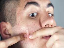 Teen Acne: Here's How To Manage Hormonal Acne In Adolescents Teen Acne: Here's How To Manage Hormonal Acne In Adolescents