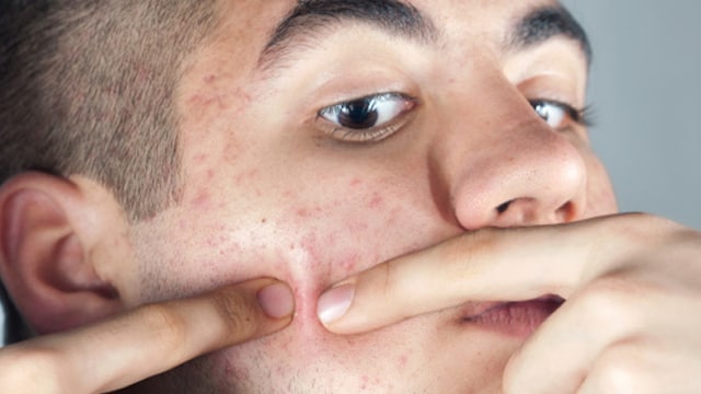 Skincare tips: Picking on acne can worsen it
