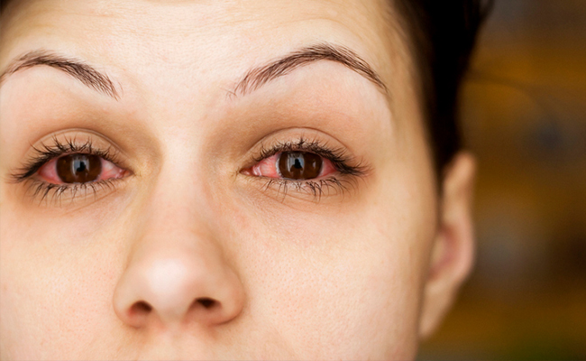 Eyes: You May be More Prone To Conjunctivitis During Monsoon, Here's How to Avoid It