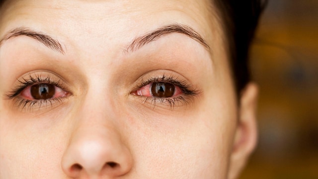 Conjunctivitis can cause redness in the eyes and irritate them