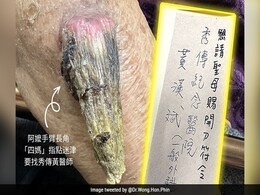Ultra-Rare "Fairy" Horn Grows On Woman's Arm In Taiwan Ultra-Rare "Fairy" Horn Grows On Woman's Arm In Taiwan