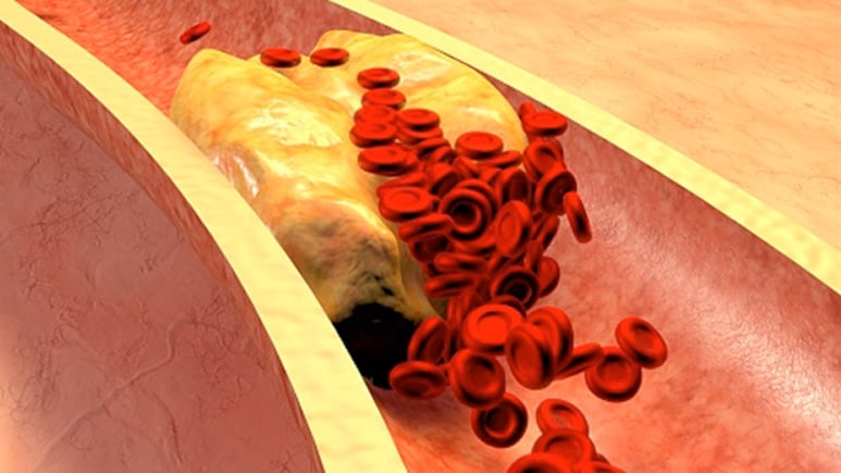 Low HDL Levels Pose Heart Health Risk: Nutritionist Shares Tips To Boost Your Good Cholesterol Naturally