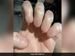 Anonychia: Viral Image Of A Person's Hand Without Nails Shocks The Internet Anonychia: Viral Image Of A Person's Hand Without Nails Shocks The Internet