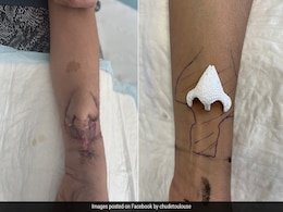 Surgeons In France Successfully Transplant Nose Grown On Woman's Arm To Her Face Surgeons In France Successfully Transplant Nose Grown On Woman's Arm To Her Face