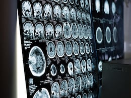 Breakthrough New Therapy Makes Deadly Brain Tumour Disappear In Days Breakthrough New Therapy Makes Deadly Brain Tumour Disappear In Days