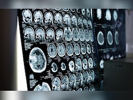 A 5-Minute Brain Scan Can Reveal Risk Of Psychosis In Patients: Study