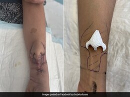 डॉक्टर ने किया कमाल, हाथ में नाक 'उगाकर', उसे ट्रांसप्लांट कर महिला के चेहरे पर लगा दिया डॉक्टर ने किया कमाल, हाथ में नाक 'उगाकर', उसे ट्रांसप्लांट कर महिला के चेहरे पर लगा दिया