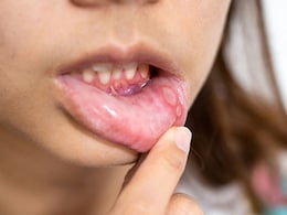 Mouth Ulcer Remedies: मुंह में हो गए हैं छाले, कुछ भी खाने और पीने में हो रही तकलीफ, इन आसान उपायों से पाएं तुरंत राहत Mouth Ulcer Remedies: मुंह में हो गए हैं छाले, कुछ भी खाने और पीने में हो रही तकलीफ, इन आसान उपायों से पाएं तुरंत राहत