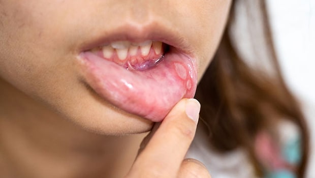 How To Cure Mouth Ulcers Naturally