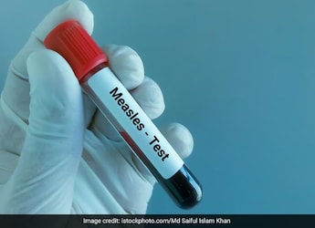 Measles Makes A Comeback: Could The US Outbreak Spark A Worldwide Spread Of Cases?