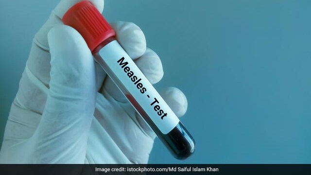 Common symptoms of measles include cough, fever, red eyes and runny nose