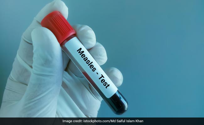 Common symptoms of measles include cough, fever, red eyes and runny nose