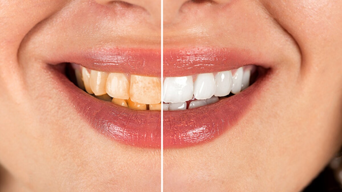 Teeth Whitening Tips ब्रश ही नहीं दांतों को चमकाने के लिए करें ये 3