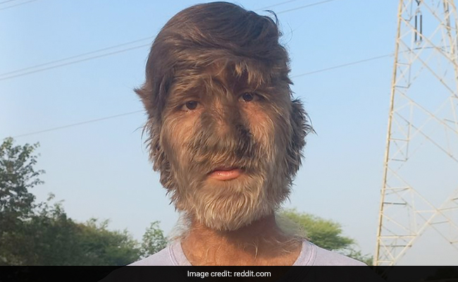 Madhya Pradesh Teen Living With Rare 'Werewolf Syndrome' Reveals How He Has Been Bullied All His Life