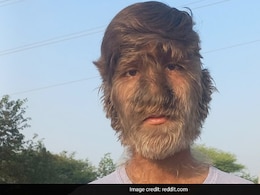 Indian Boy With Werewolf Syndrome Gets Guinness Title For Hairiest Face Indian Boy With Werewolf Syndrome Gets Guinness Title For Hairiest Face