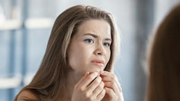 Sick Of Stubborn PCOD Acne? These Expert Diet Tips May Help You