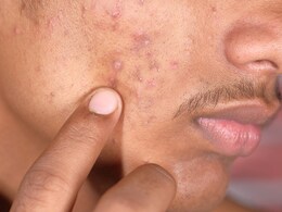 जीभ का लाल होना, मुंहासे निकलना और बालों का झड़ना इस विटामिन की कमी के हैं लक्षण