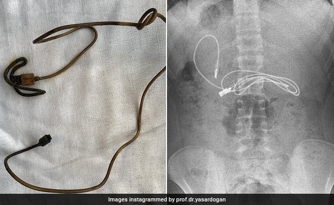 Teen In Turkey Admitted With Stomach Pain, Doctors Find Three-Feet-Long Charging Cable Inside