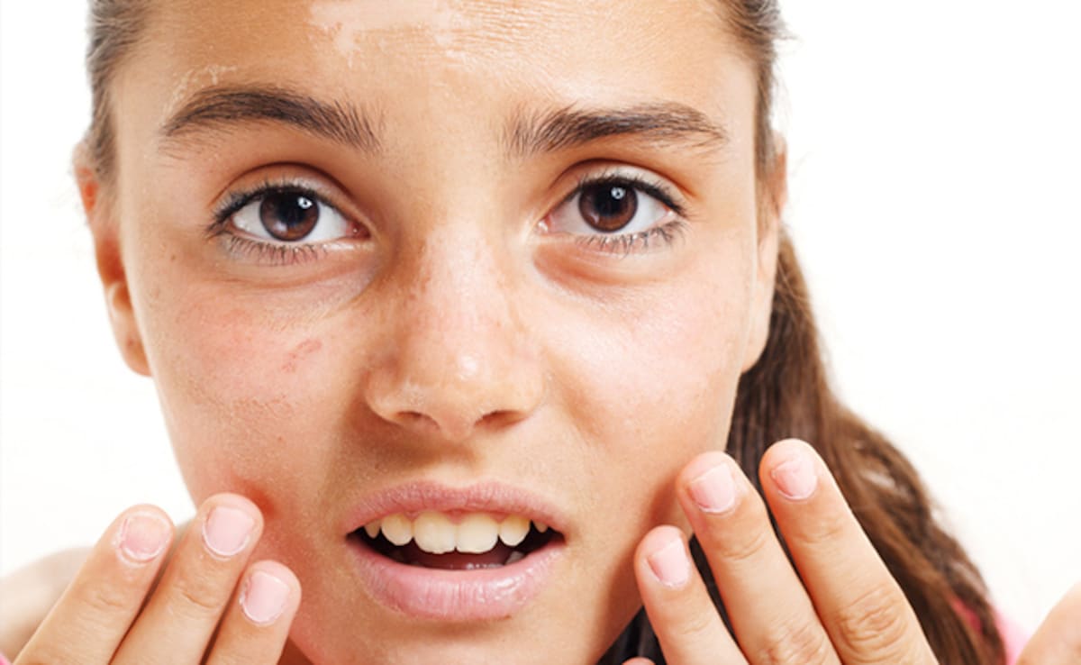 गर्मियों में स्किन को टैनिंग, सनबर्न और रूखेपन से बचाने के लिए अपनाएं ये उपाय