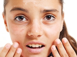 गर्मियों में स्किन को टैनिंग, सनबर्न और रूखेपन से बचाने के लिए अपनाएं ये उपाय