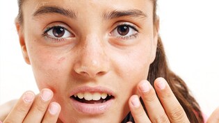 गर्मियों में स्किन को टैनिंग, सनबर्न और रूखेपन से बचाने के लिए अपनाएं ये उपाय