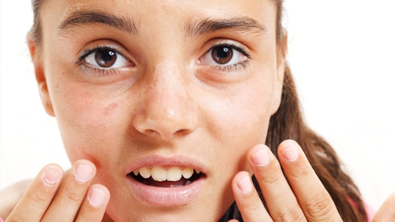 गर्मियों में स्किन को टैनिंग, सनबर्न और रूखेपन से बचाने के लिए अपनाएं ये उपाय