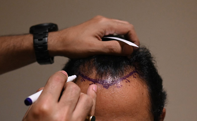 A Sudden Death Leads To Focus On Risky Hair Transplants In India