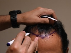 Hair Transplant For Men And Women: Plastic Surgeon Explains The Differences