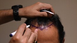 Hair Transplant For Men And Women: Plastic Surgeon Explains The Differences