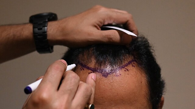 Hair Transplant For Men And Women: Plastic Surgeon Explains The Differences
