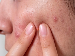 Skincare Tips: Experiencing Breakouts? These Foods Could Be The Culprit Skincare Tips: Experiencing Breakouts? These Foods Could Be The Culprit