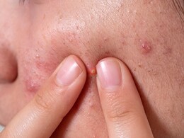 चेहरे पर बड़े-बड़े लाल दाने और सूजन इस खतरनाक बीमारी का हैं संकेत, जानें कारण और इलाज