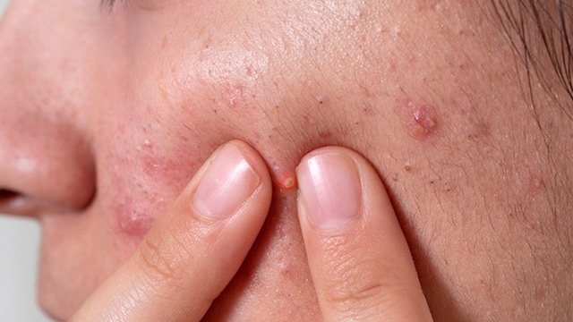 Sugar promotes the growth of bacteria in the skin that causes acne
