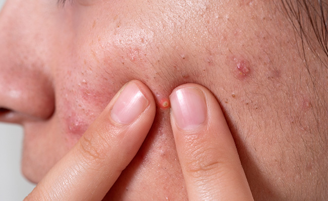 Sugar promotes the growth of bacteria in the skin that causes acne