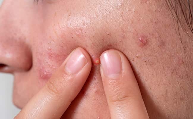 Skincare Tips: Experiencing Breakouts? These Foods Could Be The Culprit