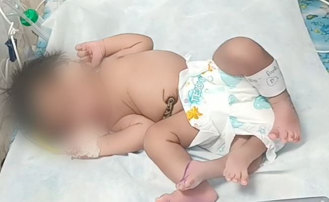 Baby Girl In Madhya Pradesh Born With 'Four' Legs