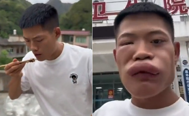 VIDEO: जिंदा ततैया खाना लड़के को पड़ा महंगा, अगले ही पल मुंह का बन गया मुखौटा!