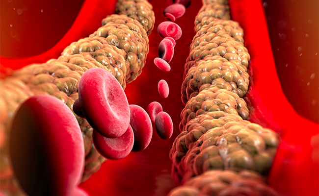 Cholesterol levels may be worsened by consuming popular yet unhealthy winter dishes