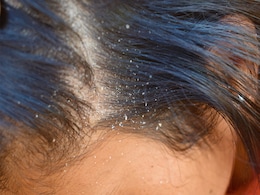 Top 3 Ways To Prevent Dandruff In Winter, According To Expert Top 3 Ways To Prevent Dandruff In Winter, According To Expert