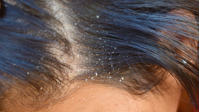 Dandruff is extremely common in winter