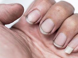 नाखूनों का रंग पीला क्यों पड़ता है और किस विटामिन की कमी का संकेत देता है? जानें कारण और उपचार