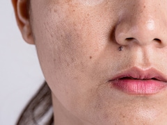 Hormones, Gut Health and Nutrition: Lovneet Batra Reveals Hidden Causes Of Pigmentation